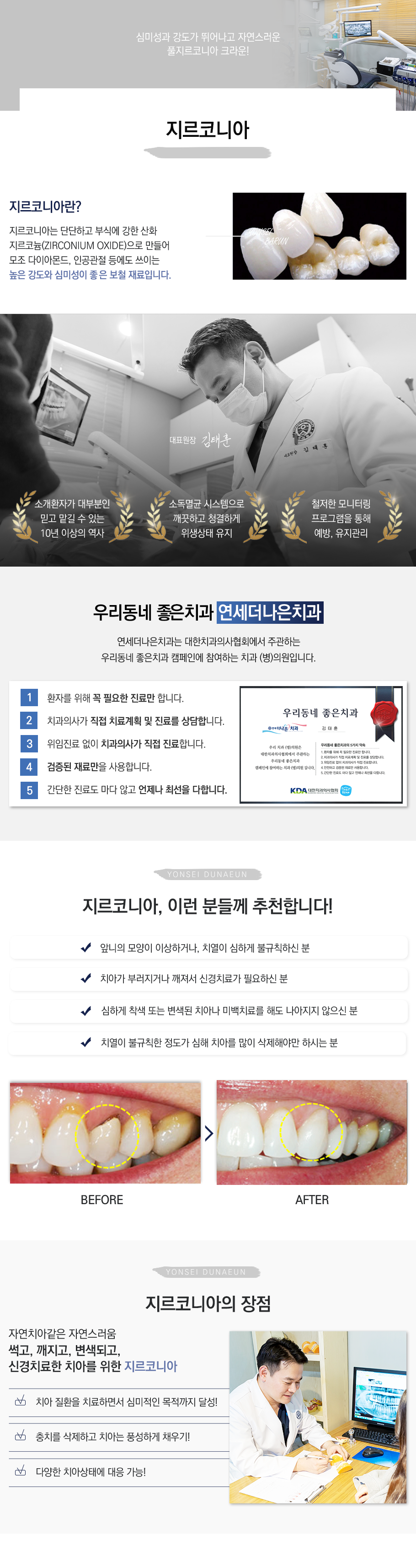 지르코니아